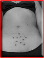 Piercing de surface "toile",  fait  relief tattoo  Valenciennes